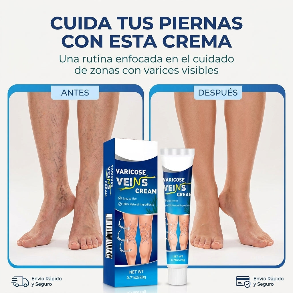 VARICES - Cuidado Diario para tus Piernas